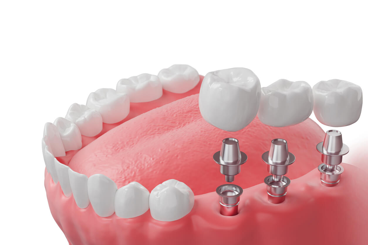 Multiple dental implants treatment at Fusion Dental Implants Sacramento CA